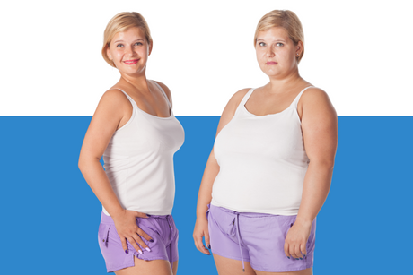 The Life-Changing Effects of Bariatric Surgery: Success Stories