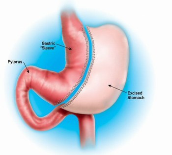 Is Gastric Sleeve Surgery Right For Me