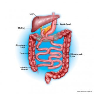 Duodenal Switch Oklahoma | WeightWise Bariatric Program