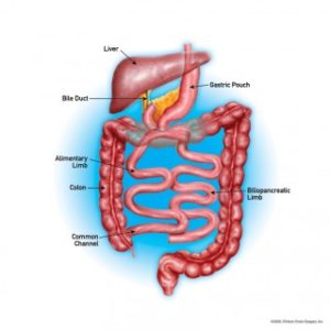 Single Anastamosis Loop Duodenal Switch | WeightWise